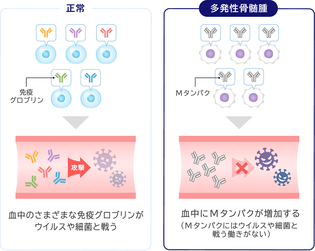 CKDに潜む多発性骨髄腫 岩崎 滋樹 先生