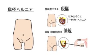 日帰り手術｜ささきクリニック｜草津駅徒歩5分の小児外科・小児科・外科