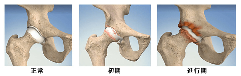 恥骨の盛り上がりや出っ張りが気になる方の骨盤は、大抵が開いているか捻れていま - リビジョン銀座（小顔矯正・美容整体） |