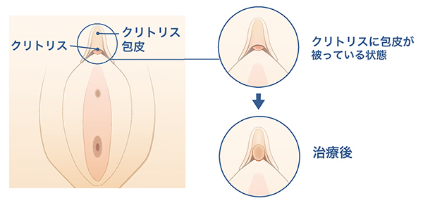 クリトリス拡張 - 淫乱なМ奴隷ひとみの調教日記