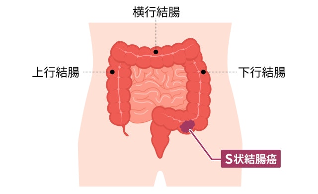 S状結腸とはなんですか？どこにありますか？ ｜S状結腸癌