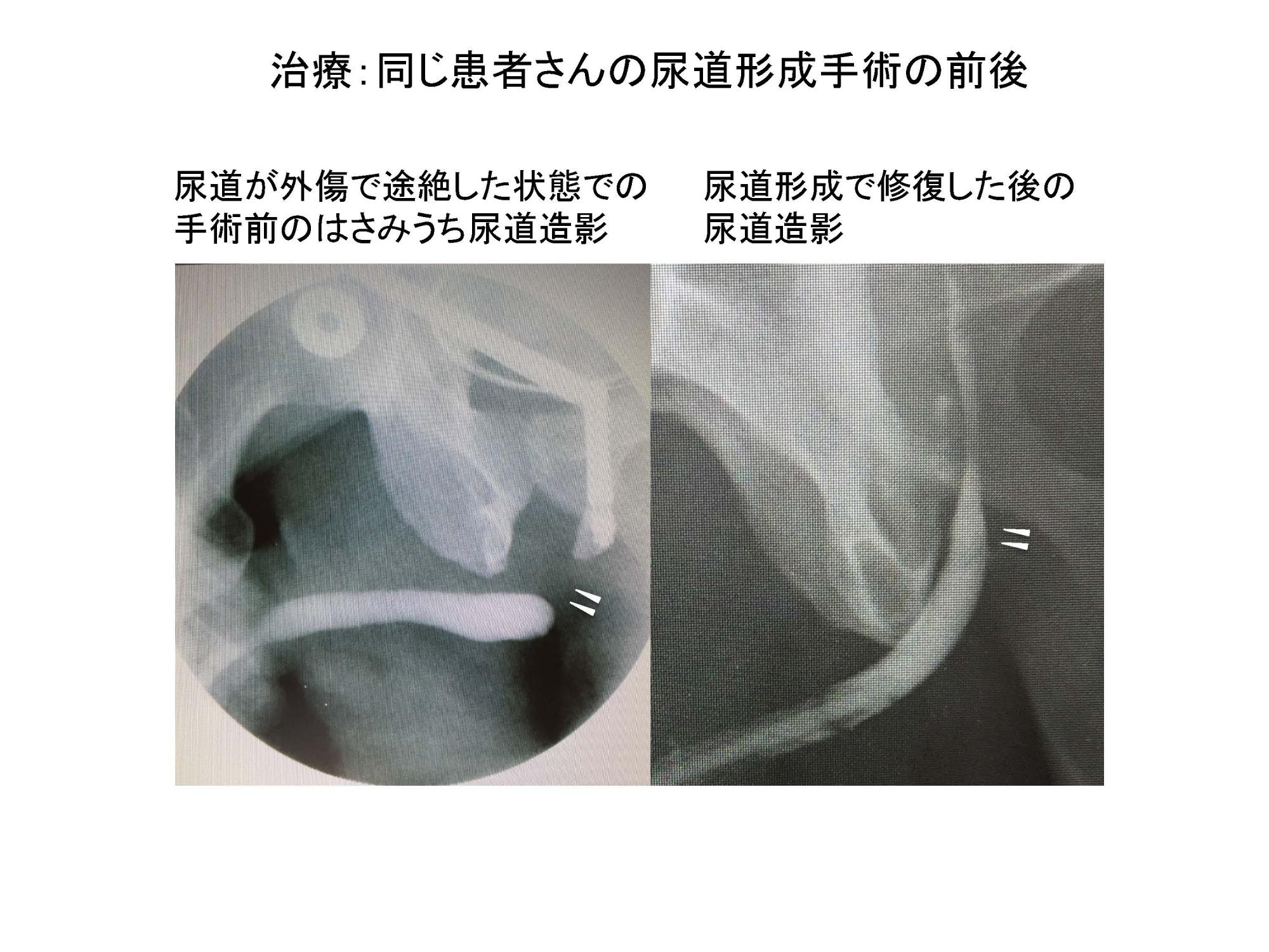 大転子引っ込める・太ももの出っ張りの原因と矯正する方法（整体師が教える美脚運動法） - 福岡の姿勢改善に強いふくだ整体院