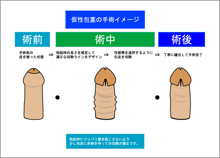 仮性包茎とは？症状・治し方等について｜MSクリニック