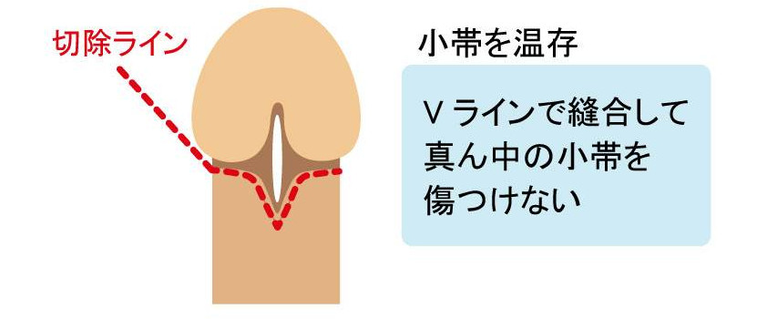 包茎とED（勃起不全）について｜【浜松町第一クリニック】