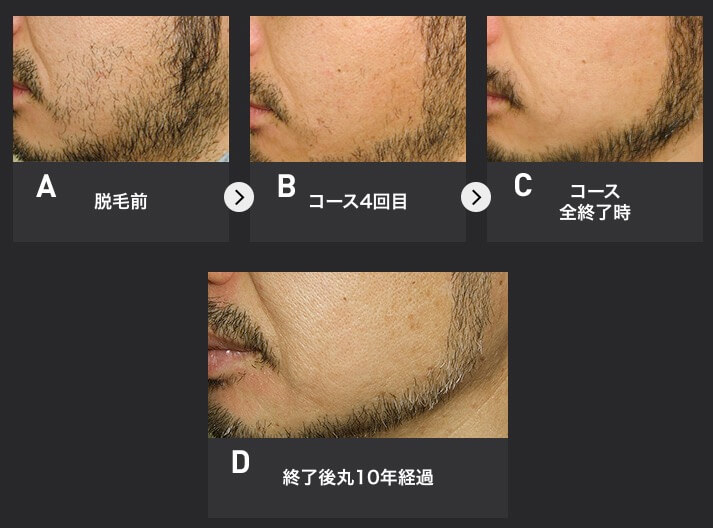 実例】メンズTBCヒゲ脱毛の料金総額は？高いようで安いと口コミで話題の理由は？ - 脱毛サロンゼミ