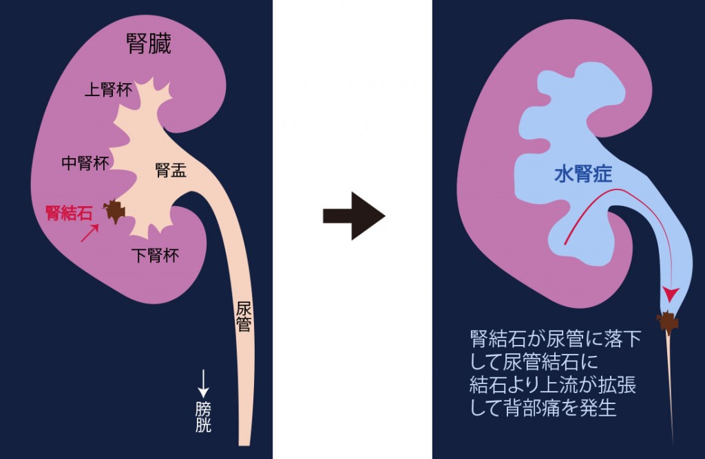 前立腺が肥大すると液が漏れる？尿モレとの関係を解説｜アテント｜エリエール｜大王製紙