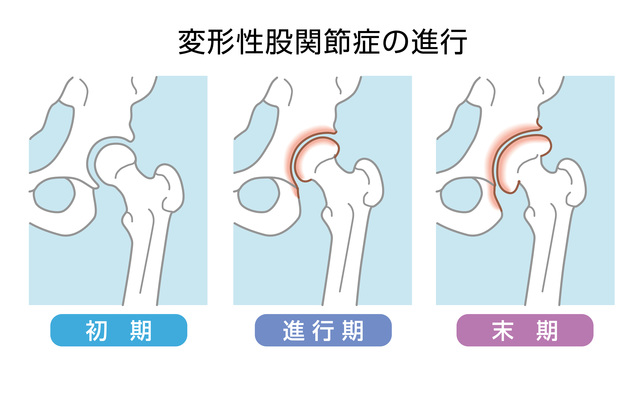 側弯症の肋骨変形は呼吸で治そう！#側弯症 #自分で治す側弯症 | TikTok