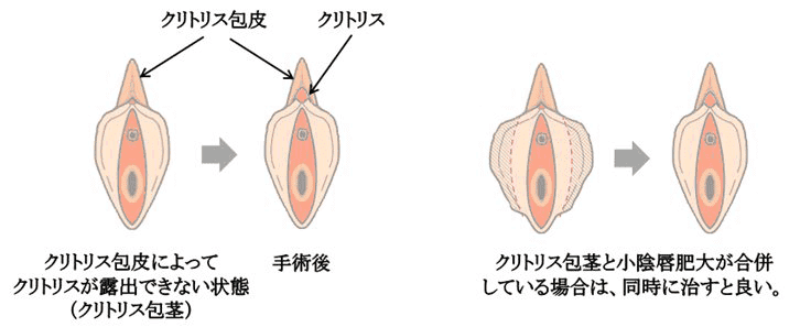 クリトリス拡張 - 淫乱なМ奴隷ひとみの調教日記