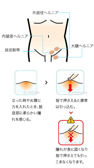 鼠径ヘルニアとは 放置は危険、日帰り手術でも治せる カラダづくり -