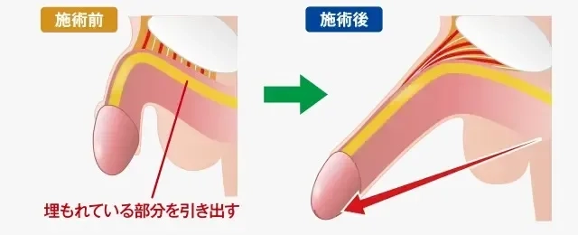 短小包茎って何？短小包茎の原因やデメリット、治療法を解説！│Welcy｜健やかな人生を毎日送るための情報共有メディア