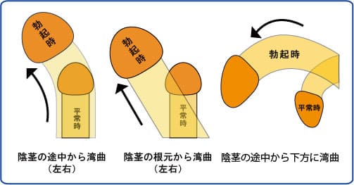 ペニスの形や大きさ | 鹿児島・福岡・東京