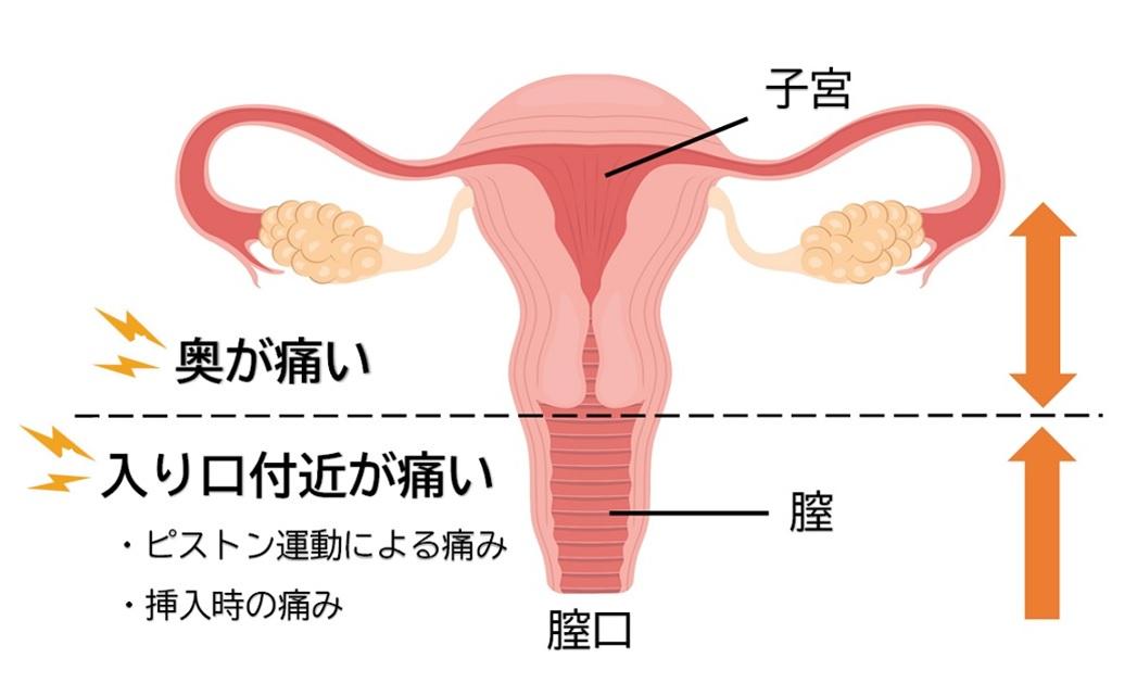 痛くて入らない！処女で膣が狭いから？セックスの悩み産婦人科医が答えます | ViVi