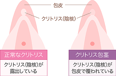 陰核（クリトリス）包茎術｜婦人科形成なら湘南美容クリニック【公式】