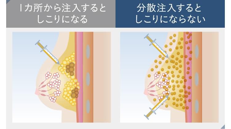 豊胸で炎上している件について - YouTube