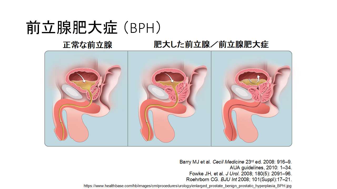 前立腺肥大症 | ～笑顔でスッキリ～ おしっこ