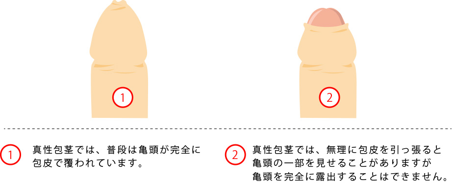 現役医師が解説】カントン包茎、真性包茎は正常にSEXができていない！ – メンズ形成外科 | 青山セレス&船橋中央クリニック