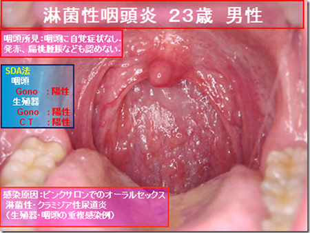 扁桃腺のはれの予防と対処法｜ハレナース・ハレナーススプレー｜小林製薬