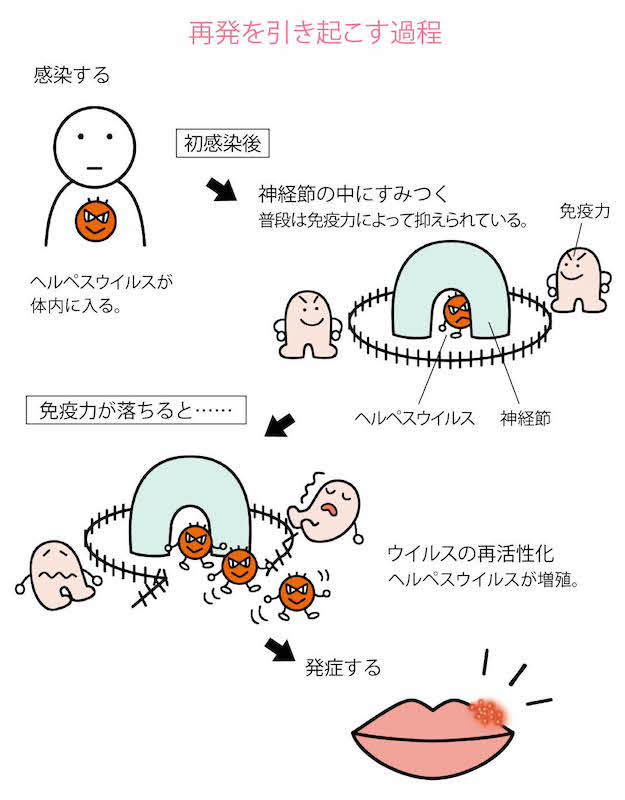 ヘルペス（口唇/性器）がうつる原因は？症状・薬・治療期間などについて【公式】東京都の池袋アイリス婦人科クリニック