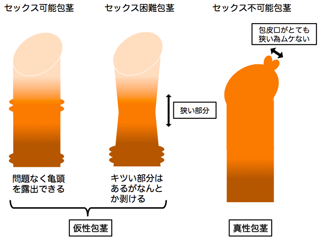 彼氏が包茎！仮性や真性などの種類と臭い - 夜の保健室