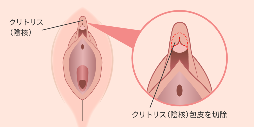 クリトリス包茎とは？悩みを解決する切除手術のメリットやリスクを解説 | コラム一覧｜  東京の婦人科形成・小陰唇縮小・婦人科形成（女性器形成）・包茎手術・膣ヒアルロン酸クリニック