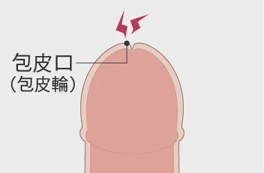 真性包茎とは？手術と費用について｜MSクリニック