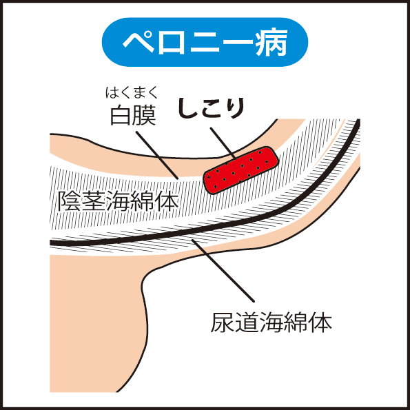 症例11 41歳男性 ペニス上反り形成術・屈曲ペニス修正術