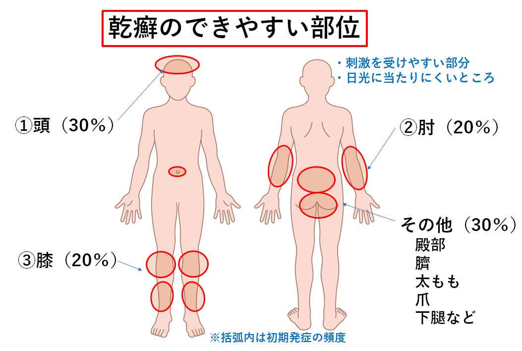 鼠径ヘルニアについて - 和光会