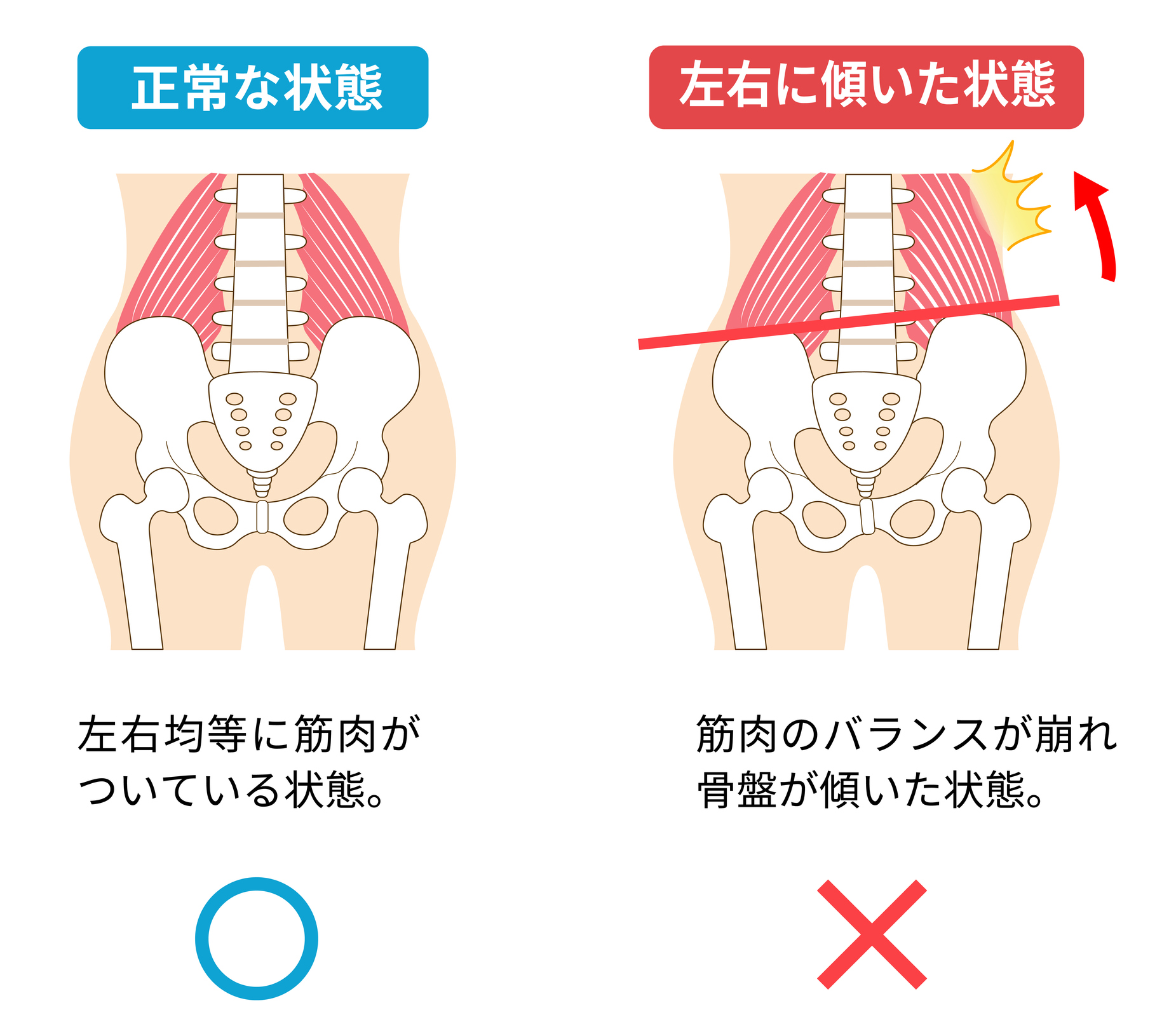 恥骨の盛り上がりや出っ張りが気になる方の骨盤は、大抵が開いているか捻れていま - リビジョン銀座（小顔矯正・美容整体）