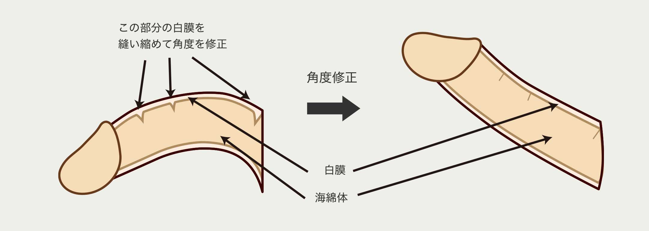 男性器 長茎術 | 診療内容