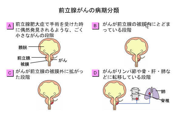 前立腺肥大症 | ～笑顔でスッキリ～ おしっこ