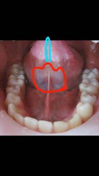 舌ピを開けたいんですが、でも裏の筋？があるんです。普通に貫通 - Yahoo!知恵袋