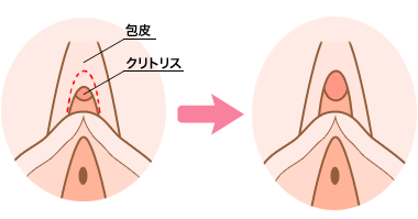 クリトリス包茎で叶える快適なインティメイトケア | ガーデンクリニック