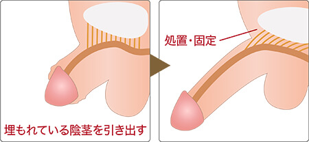 短小の基準は？短いちんこのちん長を伸ばし、粗チンを卒業する方法まとめ | Men's Chinchi