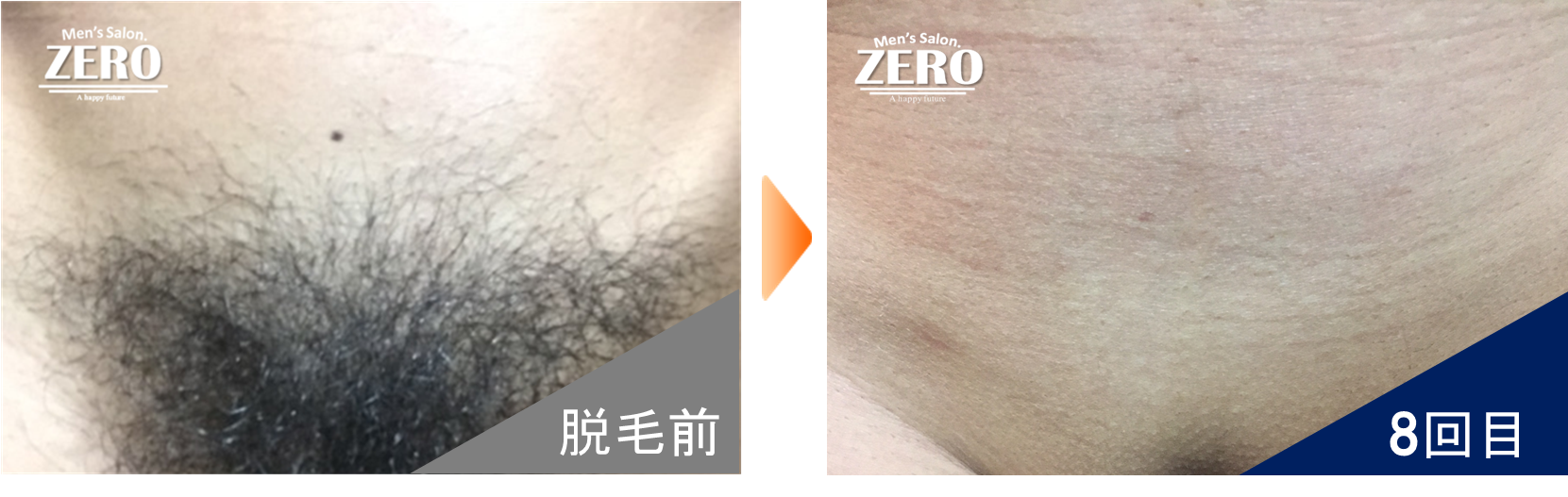 メンズ VIO脱毛 心斎橋｜大阪 男性VIO脱毛(玉竿)【ZERO】