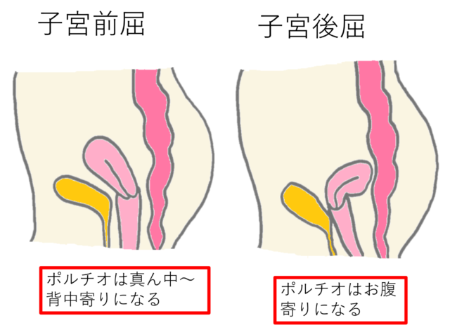 がん情報サイト | がん情報各論：[患者さん向け]膣がんの治療（PDQ®）