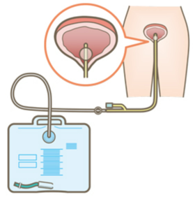 一時的導尿カテーテル挿入と抜去(男性) | 動画でわかる看護技術 |