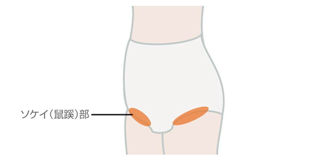 鼠径ヘルニア、穴を塞げ 中高年男性に多く、腹腔鏡手術も - 日本経済新聞