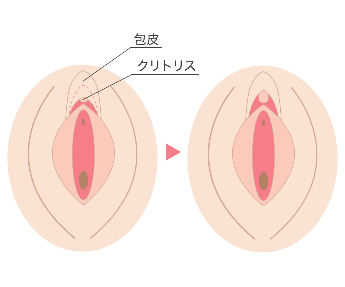 クリトリス包茎で叶える快適なインティメイトケア | ガーデンクリニック