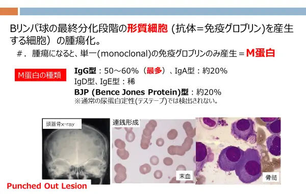 多発性骨髄腫の病期（ステージ）について教えてください | 小野薬品 がん情報 一般向け