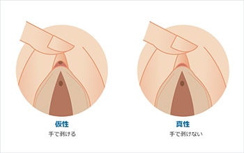 クリトリス、副皮の治療｜ルクスクリニック | 新宿にある美容外科、美容皮膚科、婦人科形成