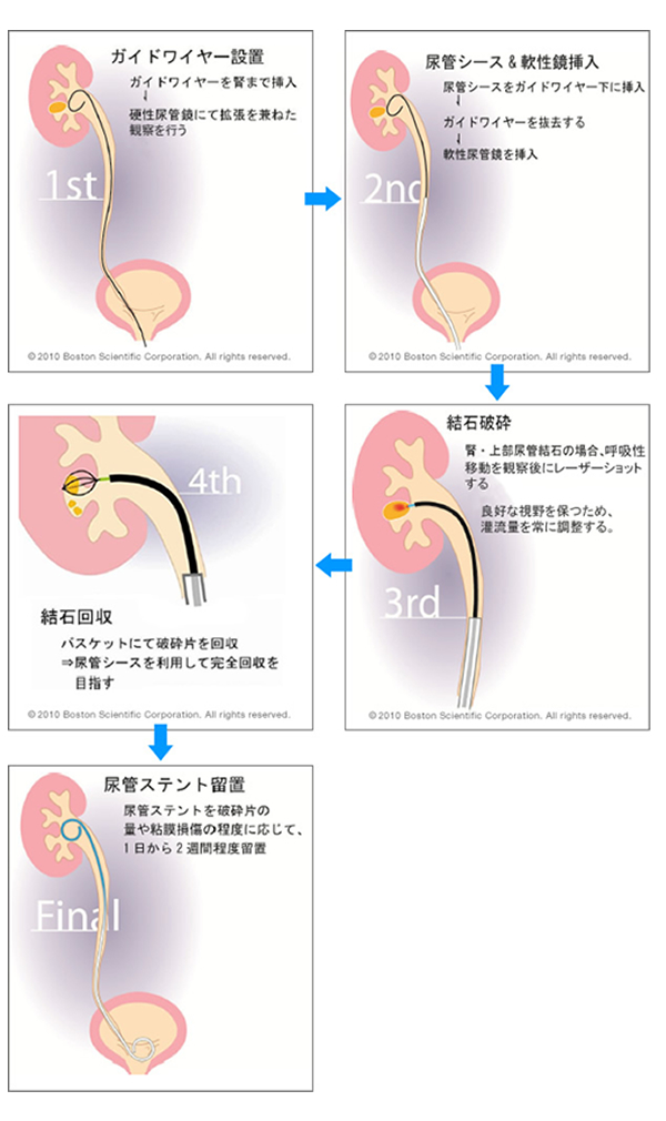 慢性前立腺炎を根本から改善する治し方「衝撃波治療」について | 大阪梅田紳士クリニック