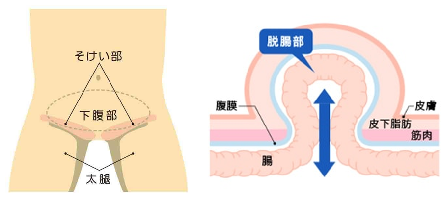 鼠径ヘルニア・脱腸（足の付け根のふくらみ・痛み・違和感）｜大阪うめだ鼠径ヘルニアMIDSクリニック