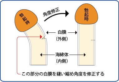 屈曲ペニス・屈曲陰茎の症例画像｜包茎の手術や治療は認定専門医に！[大阪]