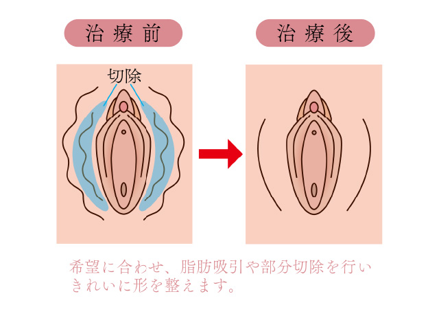 恥垢とは？溜まりやすくなる原因と治療法の解説 | コラム一覧｜