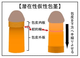 包茎・男性器治療 | 池袋セントラルクリニック