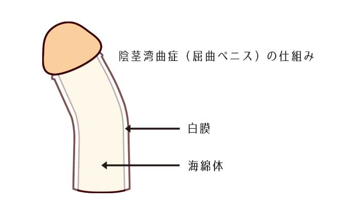 短小改善（長茎術）｜岡山中央クリニック（公式サイト）