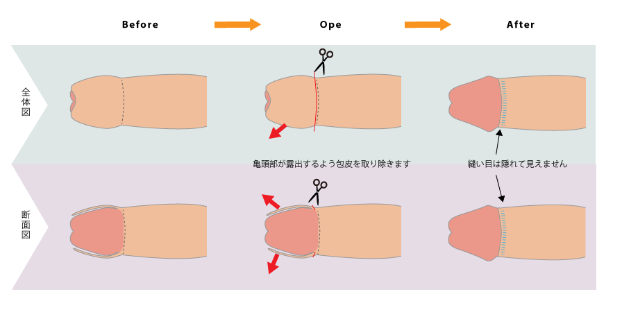 包茎手術・治療や包茎の種類について｜MSクリニック【公式】