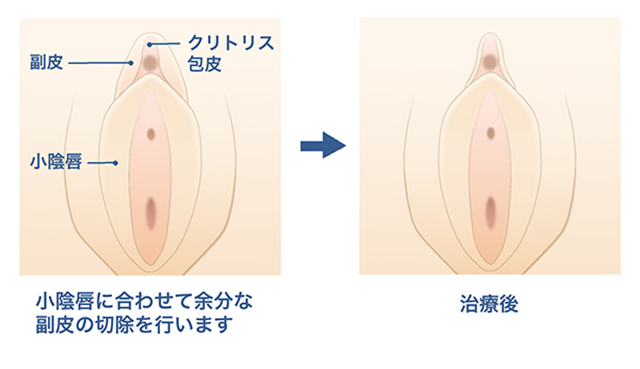 女性器形成（婦人科形成） - 渋谷の美容外科・美容整形クリニック