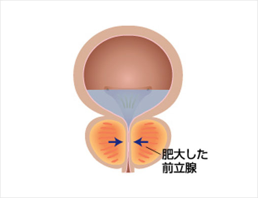 慢性前立腺炎｜神戸市東灘区 摂津本山｜いしむら腎泌尿器科クリニック