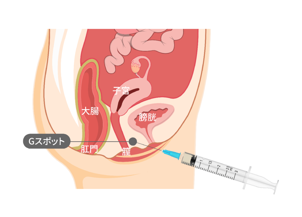 Gショット（不感症治療）の特徴と効果説明・女性医師の指名可能｜【公式】オザキクリニック（新宿・目黒祐天寺・羽村）